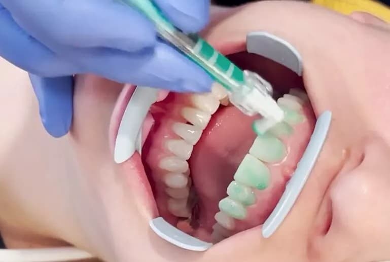 ICON – leczenie białych plam